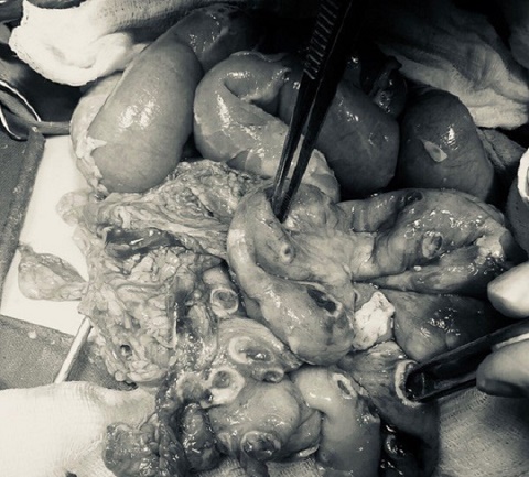 Bé trai 2 tuổi bị thủng tới 50 lỗ ở ruột do ấu trùng giun chó, mèo