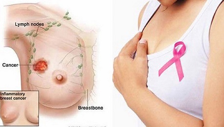 Bệnh viện Ung Bướu TP.HCM: Tầm soát ung thư vú (miễn phí) cho phụ nữ