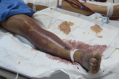 Ăn tiết canh lợn, người đàn ông nhập viện trong tình trạng nguy kịch