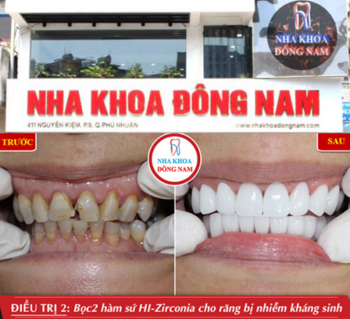 TP.HCM: Top 5 Địa Điểm Trồng Răng Sứ Đẹp Nhất