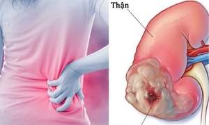 Những dấu hiệu âm thầm của ung thư thận dễ bị bỏ qua