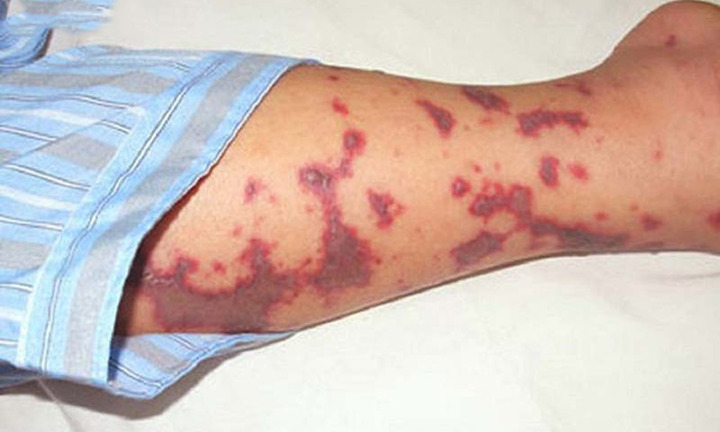 Não mô cầu tăng mạnh, trẻ em chiếm gần 50% ca mắc, nhận diện dấu hiệu 'tử thần'